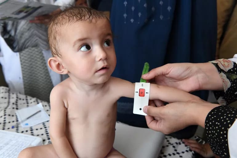 Malnutrition in Afghanistan - (File Photo: UNICEF)