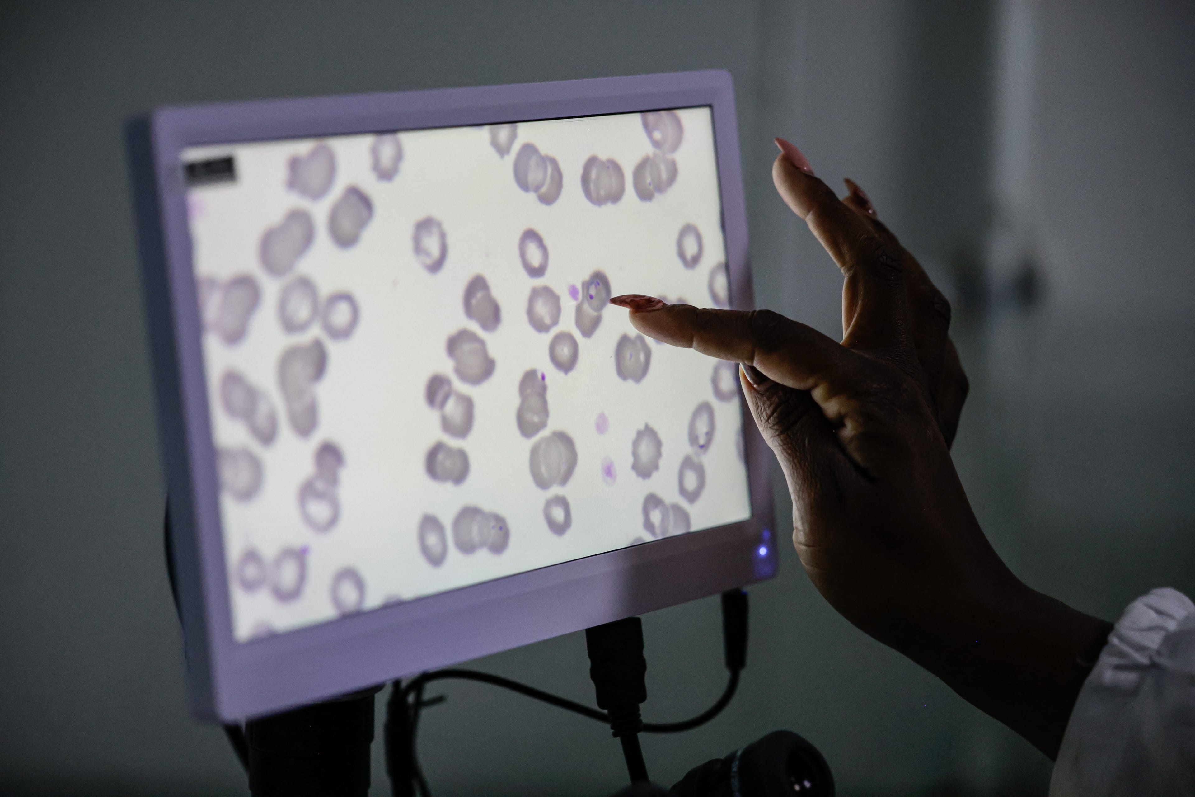 Medical technologist and laboratory manager at the National Health Laboratory Service Rirhandzu Mashale points to a malaria-positive blood sample projected from a microscope at Tintswalo Hospital in Bushbuckridge on May 26, 2026. (AFP)